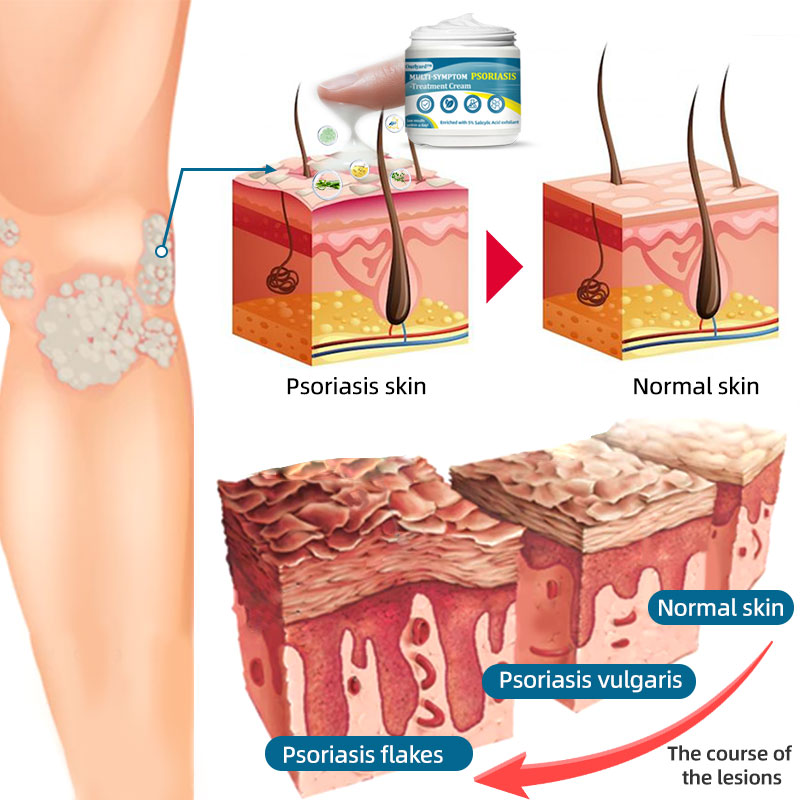 Ourlyard™ Multi-Symptom Psoriasis Treatment Cream (👨‍⚕Doctor's Recommendation)